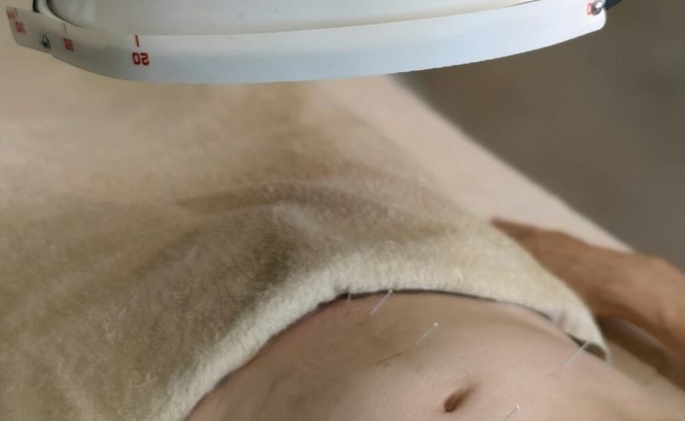 Close-up of a person's abdomen with acupuncture needles inserted, partially covered by a beige towel, under a round therapy lamp—illustrating bioenergetic therapy for inflammation and gut health.
