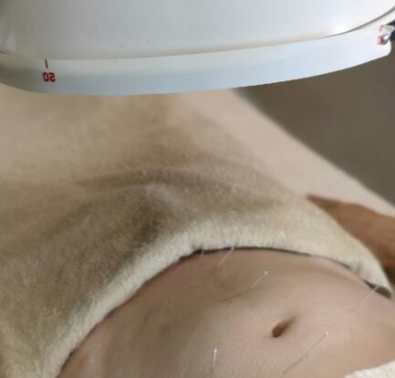 Close-up of a person's abdomen with acupuncture needles inserted, partially covered by a beige towel, under a round therapy lamp—illustrating bioenergetic therapy for inflammation and gut health.